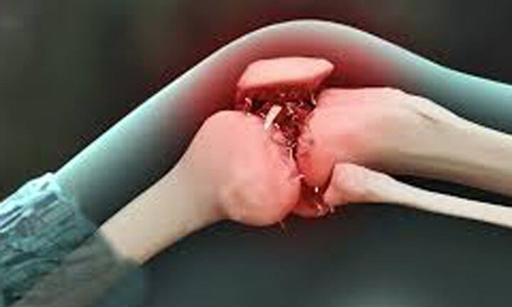 Những điều nên biết về bệnh ung thư xương