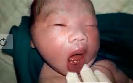 Kỳ lạ: Em bé vừa chào đời đã mọc răng cửa