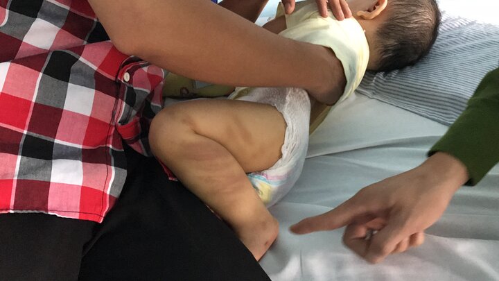Bé trai 1 tuổi nghi bị bạo hành đã được ra viện