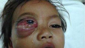 Bé trai 16 tháng tuổi mắt sưng như quả trứng gà vì viêm xoang gây biến chứng