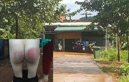 Cô giáo dùng thước đánh bầm dập mông học sinh khiến phụ huynh phẫn nộ