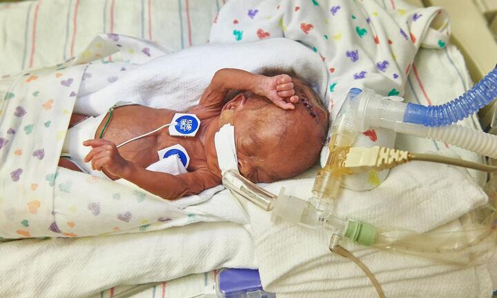 Những nguy cơ mà trẻ sinh non phải đối mặt