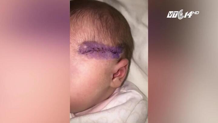 Anh: Bác sỹ sản rạch dao vào đầu trẻ khi mổ đẻ