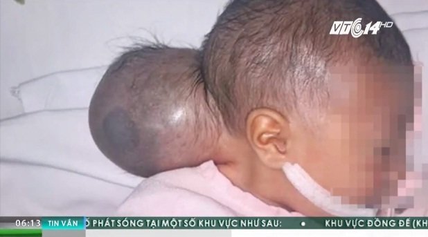 Xót xa bé sơ sinh 2 ngày tuổi có bướu khổng lồ bị người nhà bỏ rơi ở bệnh viện