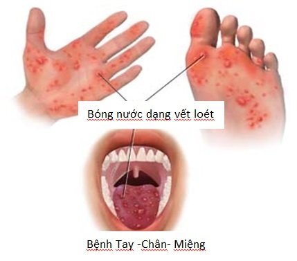 Sắp khai giảng, Bộ Y tế khuyến cáo nguy cơ dịch tay chân miệng bùng phát