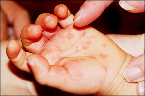 Video: Nguy cơ bùng phát dịch tay chân miêng