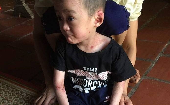 Mắc bệnh hiếm gặp không thể chữa khỏi, bé 5 tuổi ở Phú Thọ cầu cứu trong tuyệt vọng