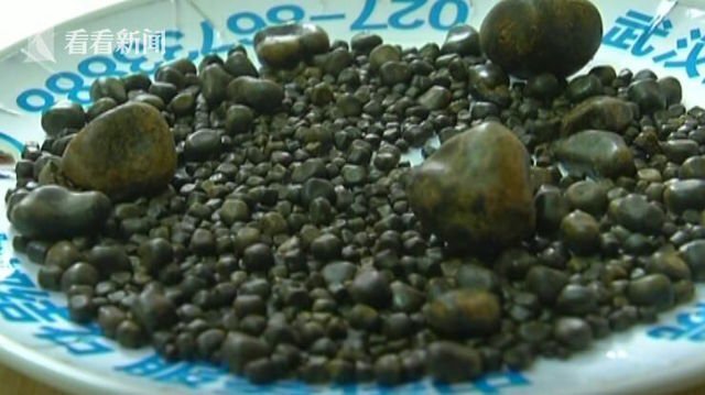 Bác sỹ lấy 806 viên sỏi từ túi mật của bệnh nhân thích ăn thịt mỡ