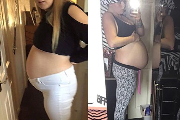 Mang thai 6 tuần nhưng bụng to như 8 tháng, người mẹ sốc nặng khi biết mình mang trọng bệnh