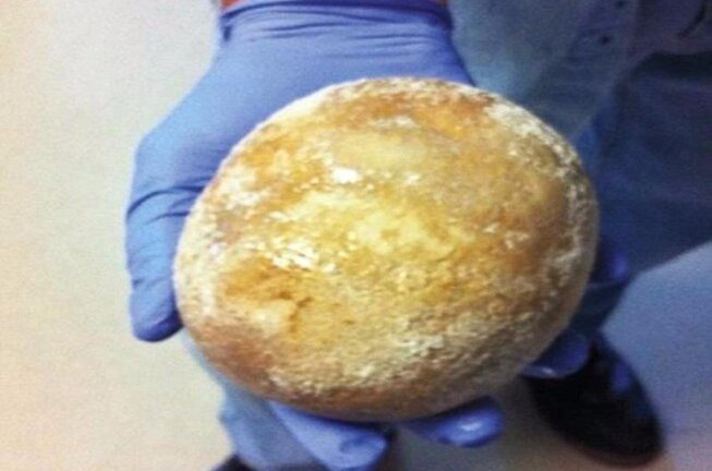 Viên sỏi bàng quang ‘khủng’ to như trứng đà điểu