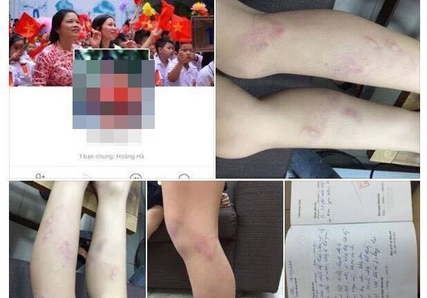 Cô giáo đánh tím chân học sinh do vào lớp chậm: Thông tin mới nhất