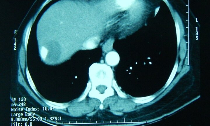 Phá thành công khối u gan kích thước lớn dính liền màng phổi