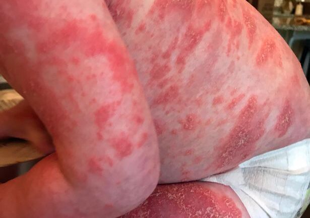 Em bé 20 tháng tuổi mắc căn bệnh đáng sợ khiến toàn thân phồng rộp, bong tróc