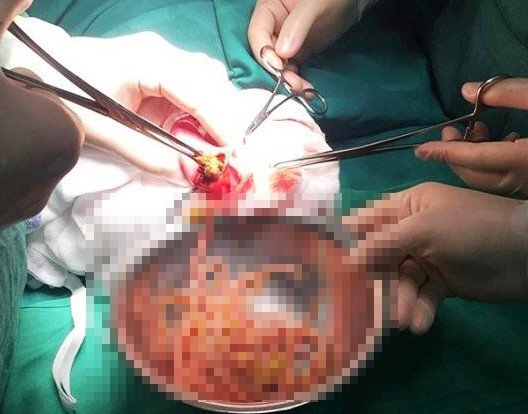 Búi giun hơn 1kg gây tắc ruột bé gái 3 tuổi ở Nghệ An