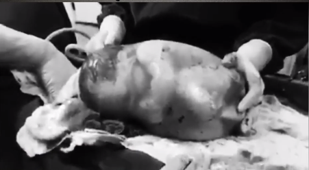 Ngỡ ngàng em bé ra đời vẫn nằm nguyên trong túi nước ối