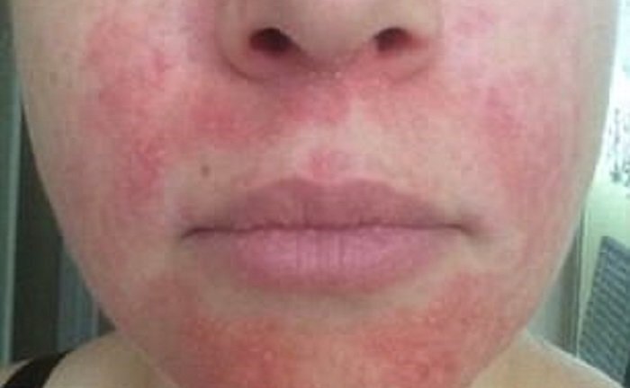 Tác dụng bất ngờ của 'thần dược' mật ong