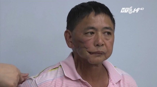 Sốc: Nhiều người bị ung thư miệng do nhai trầu