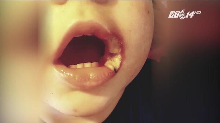 Ngậm sạc điện thoại, bé 19 tháng tuổi bỏng nặng, suýt mất môi