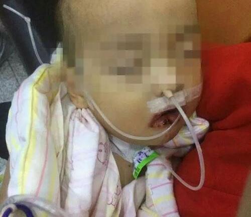 Ăn nhầm thuốc tẩy, bé trai 1 tuổi bị bỏng nặng khắp người