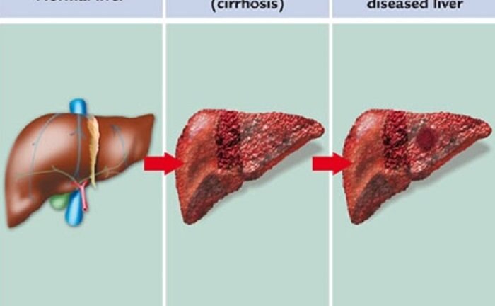 Chữa ung thư gan thế nào để kéo dài sự sống thêm nhiều năm?