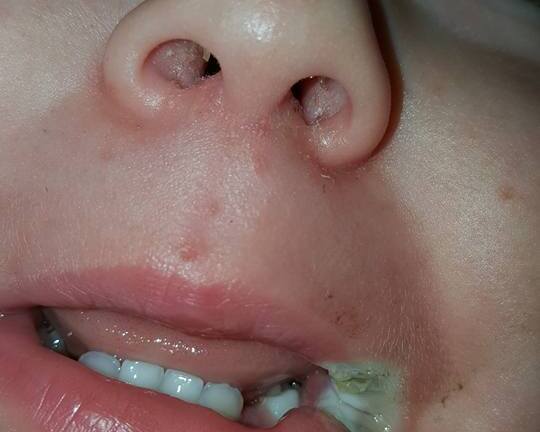 Bé gái 19 tháng bỏng nặng, mất một phần miệng vì ngậm sạc điện thoại