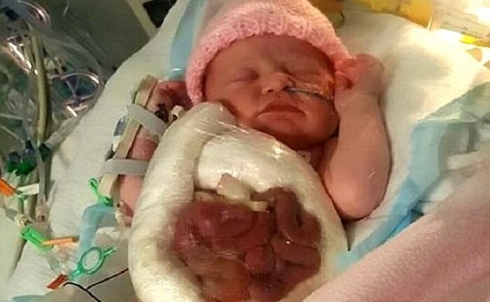 Xót xa hình ảnh bé gái bị xổ ruột bẩm sinh