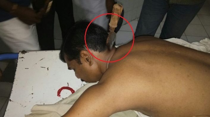 Bị dao đâm sâu 15cm vào gáy, người đàn ông sống sót kỳ diệu