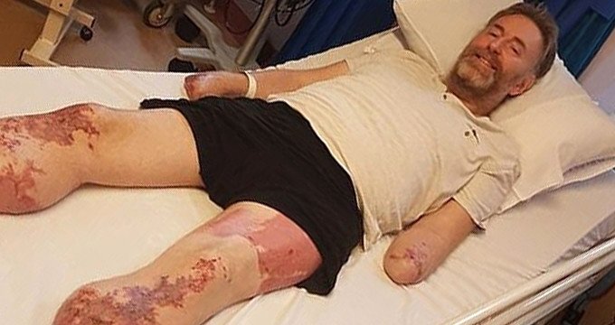 Tưởng chỉ cảm lạnh, người đàn ông phải cắt cụt chân tay chỉ sau 1 ngày