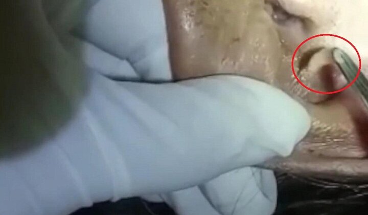 Kinh hãi cảnh gắp 30 con giòi sống lúc nhúc trong tai cụ bà 76 tuổi