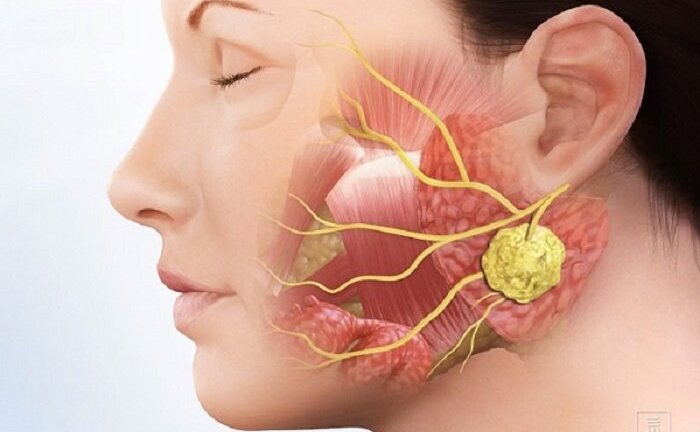 Mùa đông cẩn trọng kẻo mắc quai bị