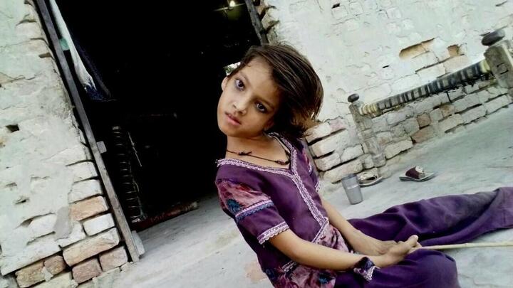 Đáng thương bé gái có chiếc đầu 'vẹo' vuông góc với cơ thể