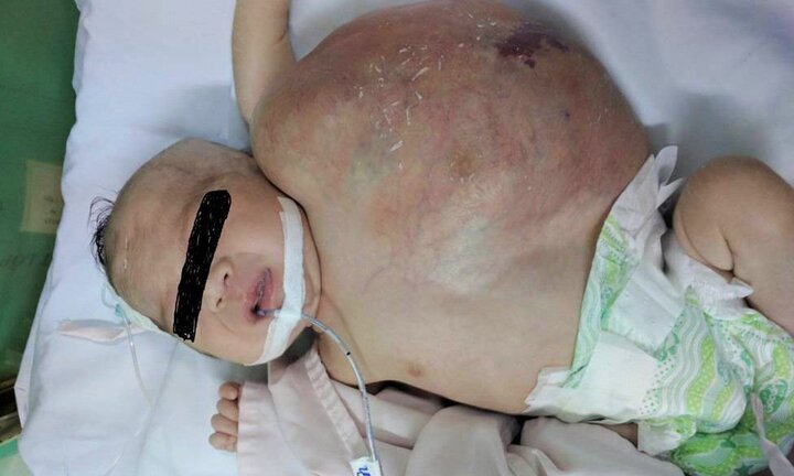 Bé gái 20 ngày tuổi bị khối u to bằng cơ thể gây nhiễm trùng nặng