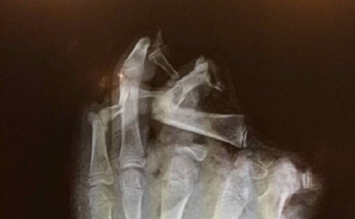 Chơi pháo trong lễ hội, nam thanh niên bị phá nát bàn tay