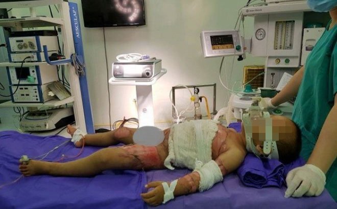 Bị dội nước sôi, bé trai 2 tuổi bỏng nặng, toàn thân bong tróc