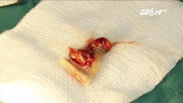 Suýt chết vì chữa hóc xương gà theo mẹo dân gian