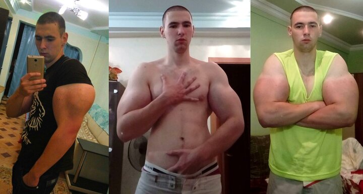 Tiêm chất tăng cơ bắp để có bắp tay 60cm, thanh niên 21 tuổi suýt mất mạng