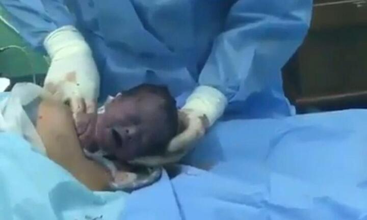 Hy hữu: Em bé tự bò ra khỏi bụng mẹ thông qua vết mổ