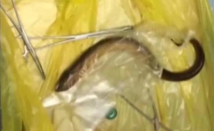 Bác sỹ Trung Quốc cứu được người đàn ông nhét lươn 50 cm vào hậu môn