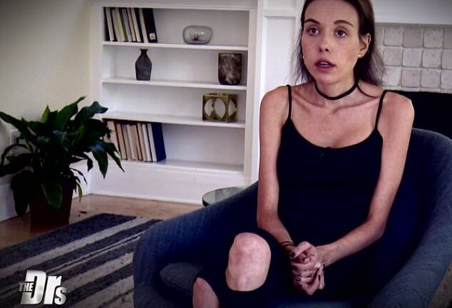 Say mê giảm béo, thiếu nữ gây 'choáng' với thân hình như 'bộ xương di động'