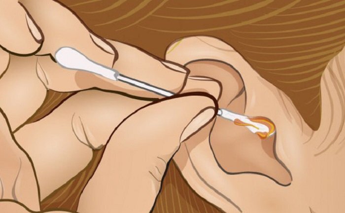 Để ý màu sắc của ráy tai, có thể biết được mắc bệnh gì