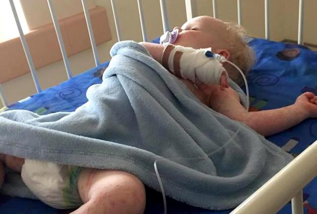 Bé trai 16 tháng bị mụn rộp lở loét khắp người vì nụ hôn của người lạ