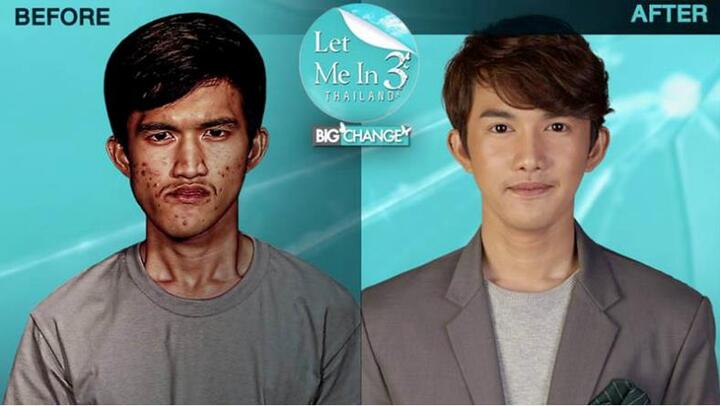 Chàng trai 22 tuổi lột xác như nam thần Hàn Quốc sau thẩm mỹ