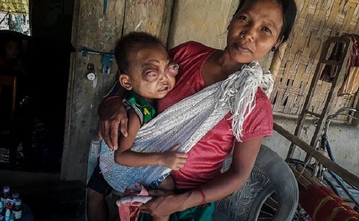 Cậu bé mắt lồi chấn động thế giới sẽ được điều trị