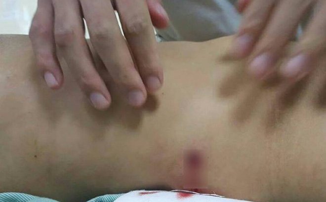 Nhóm thanh niên hỗn chiến, cô gái đi đường bị đạn lạc xuyên thủng bụng