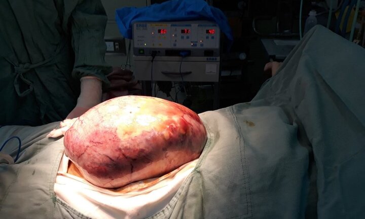 Khối u buồng trứng nặng 5kg trong bụng bệnh nhân ở Quảng Bình
