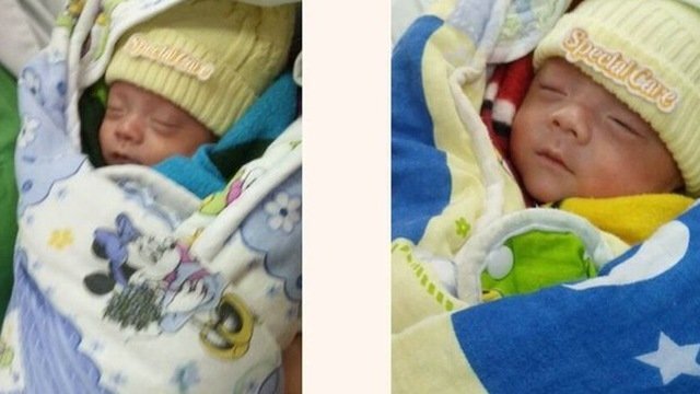 Cặp song sinh nhỏ nhất Việt Nam giờ ra sao?