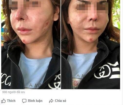 Phát hoảng với khuôn mặt biến dạng lồi lõm của hotgirl sau khi tiêm silicon