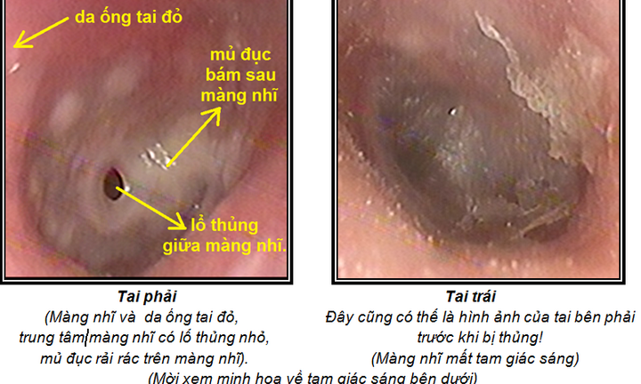 Hôn tai: 'Sát thủ' thầm lặng gây thủng màng nhỉ