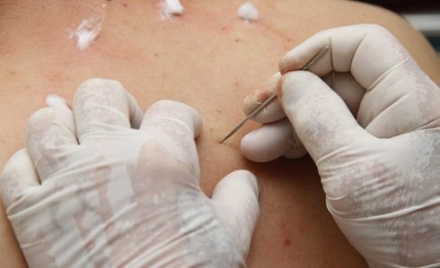 'Thầy lang vườn' chích lễ nặn máu độc, bé trai 9 tuổi suýt hoại tử chân