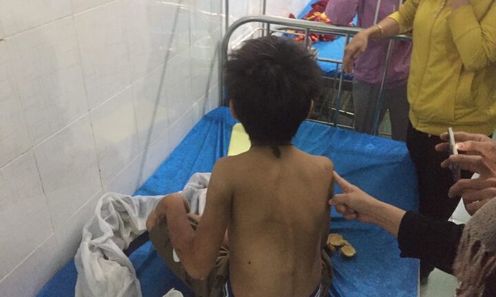 Cha ruột nhậu say, đánh đập dã man bé trai 11 tuổi